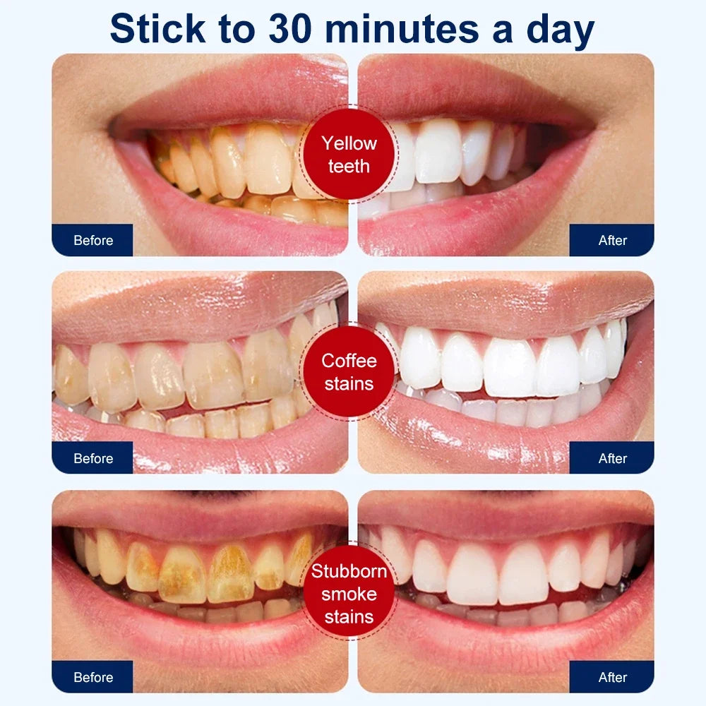 BrightSmile Pro Whitening Strips