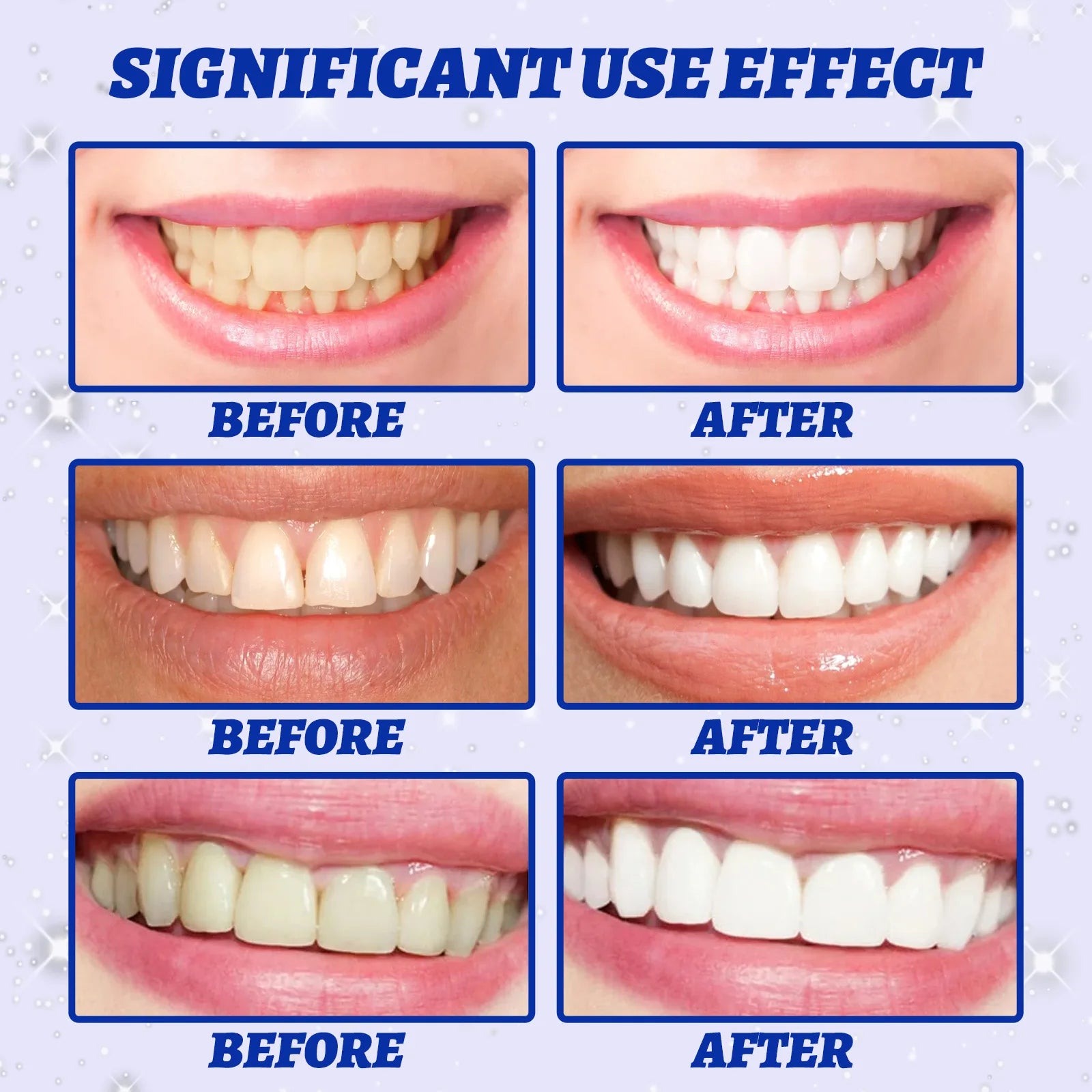 BrightSmile Pro Whitening Strips